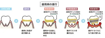 🚬タバコ（電子タバコ含む）と歯周病の関係